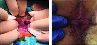 Before and After Anal Fissure Repair