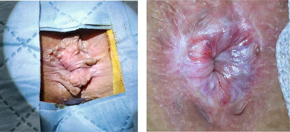 Before and After Anal Fissure Repair