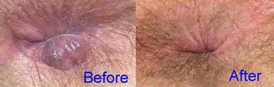 Before and After Advanced Laser Piles Treatment
